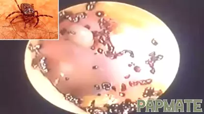 Disturbing Discovery: Ear Infestation in Young Girl